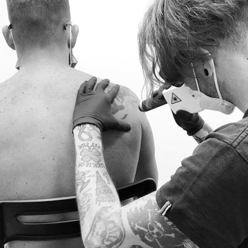 Eliminar tatuaje en Barcelona