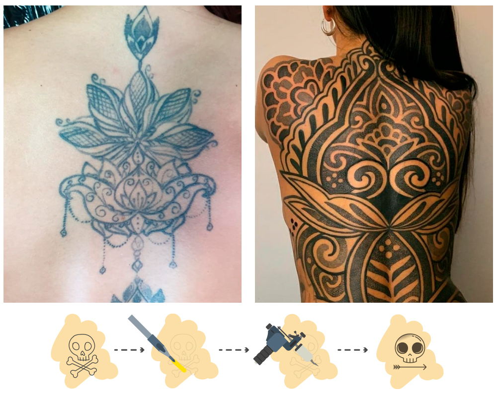 Eliminación de tatuajes con láser para cover