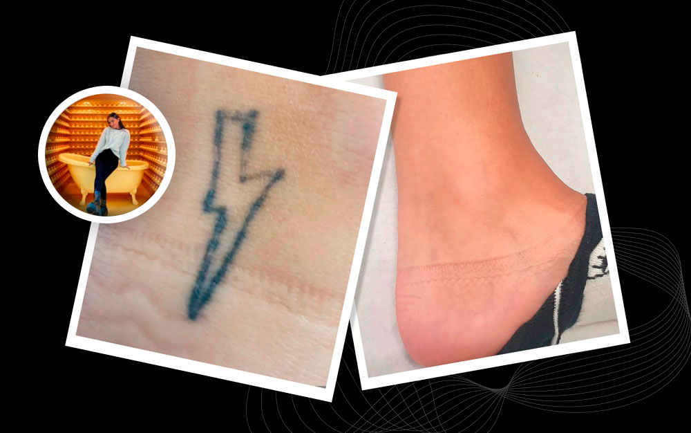 Entrevista Andrea Carbonell eliminación de tatuajes con láser